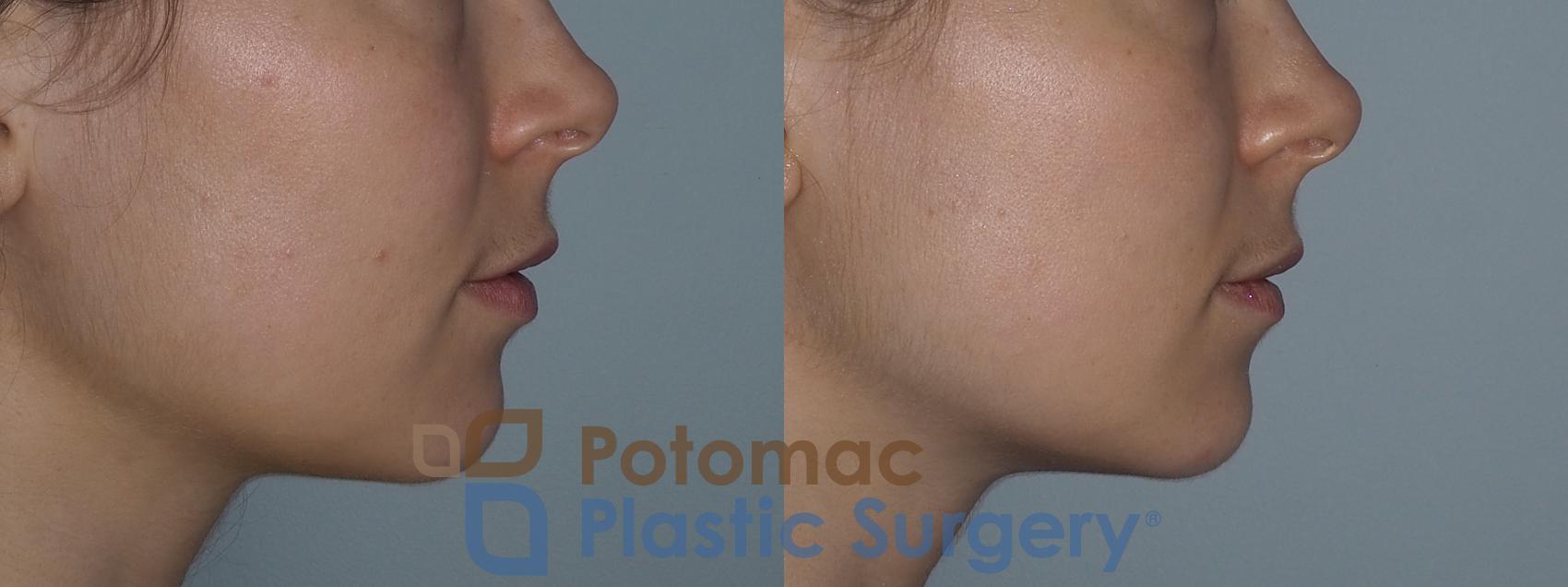 Before & After Botox Cosmetic Case 222 Right Side View in Washington, DC