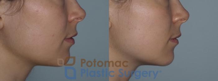 Before & After Botox Cosmetic Case 222 Right Side View in Washington DC & Arlington , DC