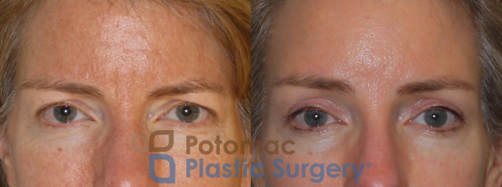 Before & After Brow Lift Case 102 Front View #2 View in Washington, DC