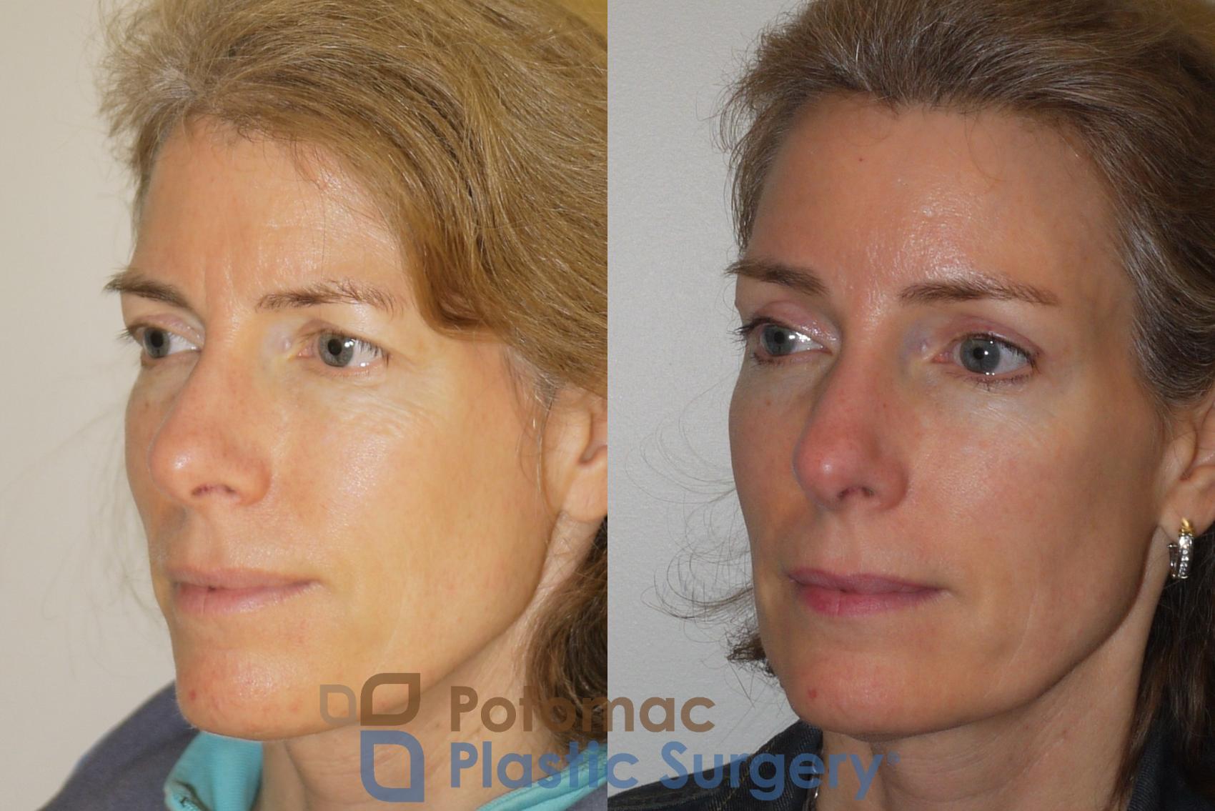 Before & After Brow Lift Case 102 Left Oblique View in Washington, DC