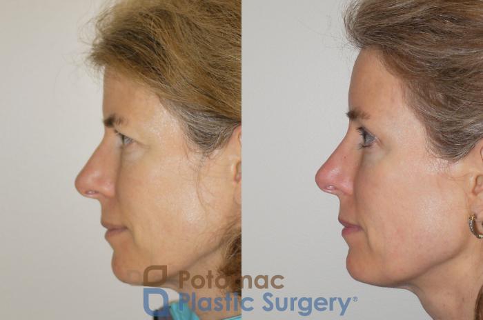 Before & After Brow Lift Case 102 Left Side View in Washington, DC