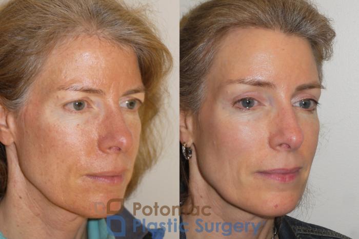 Before & After Brow Lift Case 102 Right Oblique View in Washington, DC