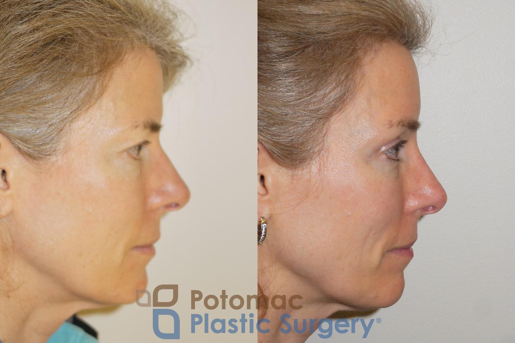 Before & After Brow Lift Case 102 Right Side View in Washington, DC