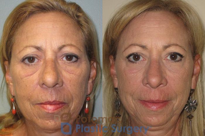 Before & After Skin Care Case 15 Front View in Washington, DC