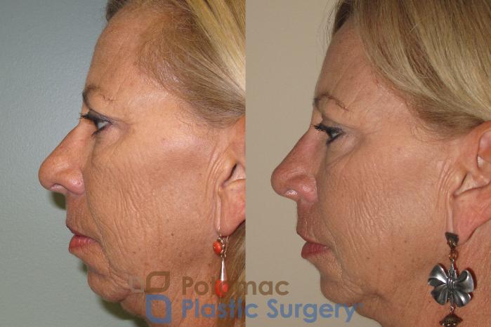 Before & After Brow Lift Case 15 Left Side View in Washington, DC