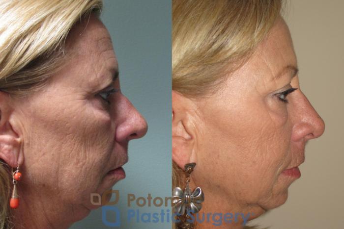 Before & After Brow Lift Case 15 Right Side View in Washington, DC