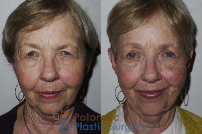 Before & After Blepharoplasty Case 176 Front View in Washington DC & Arlington , DC