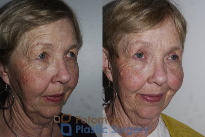 Before & After Blepharoplasty Case 176 Right Oblique View in Washington DC & Arlington , DC