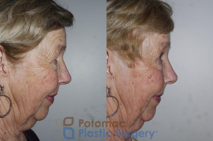 Before & After Brow Lift Case 176 Right Side View in Washington DC & Arlington , DC