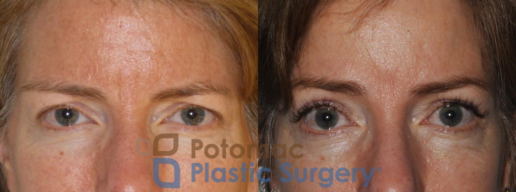 Before & After Brow Lift Case 198 Front Close-Up View  View in Washington, DC