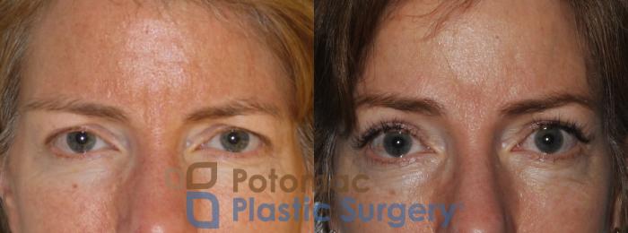 Before & After Brow Lift Case 198 Front Close-Up View  View in Washington, DC
