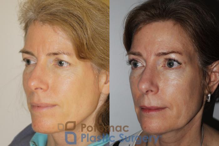 Before & After Brow Lift Case 198 Left Oblique View in Washington, DC