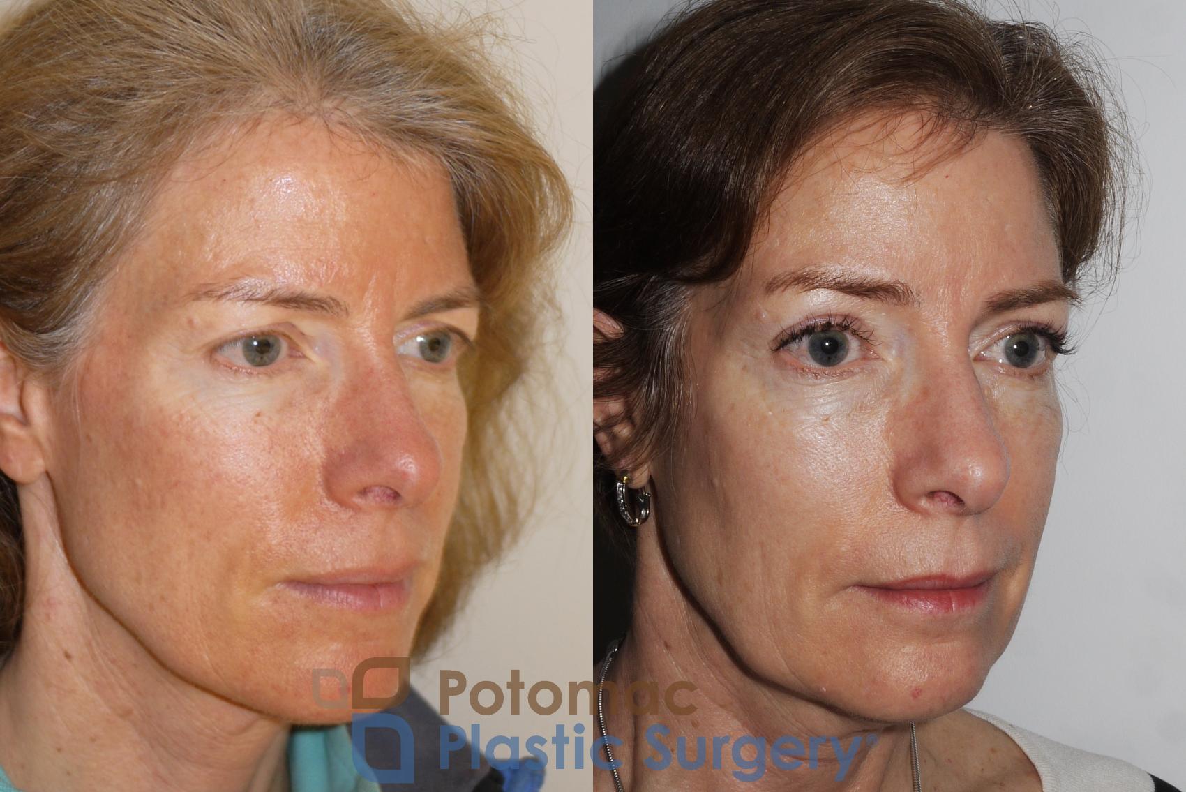 Before & After Brow Lift Case 198 Right Oblique View in Washington, DC
