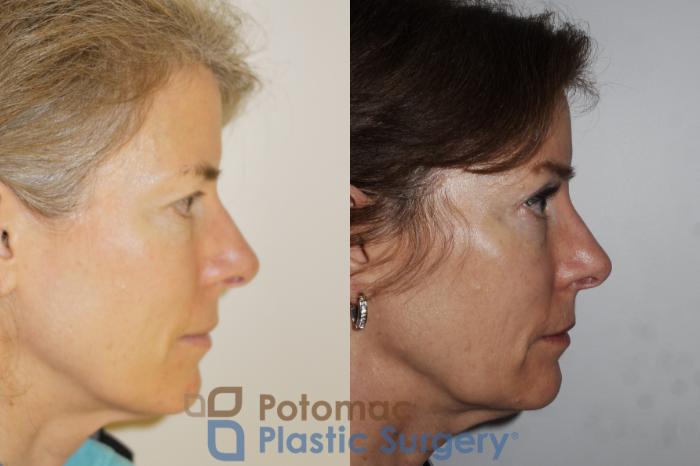 Before & After Brow Lift Case 198 Right Side View in Washington, DC
