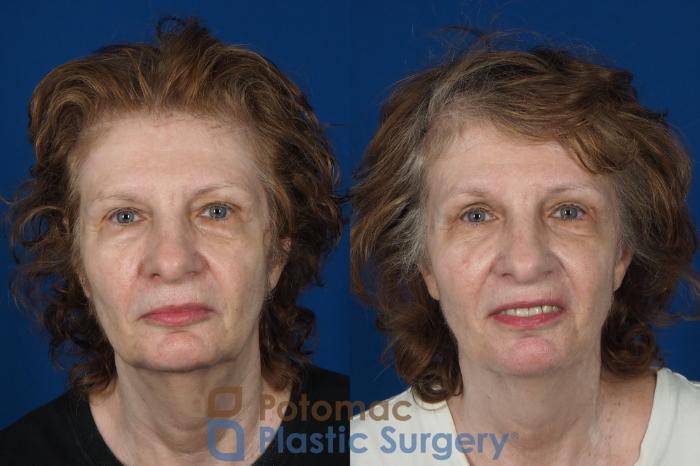 Before & After Brow Lift Case 245 Front View in Washington DC & Arlington , DC