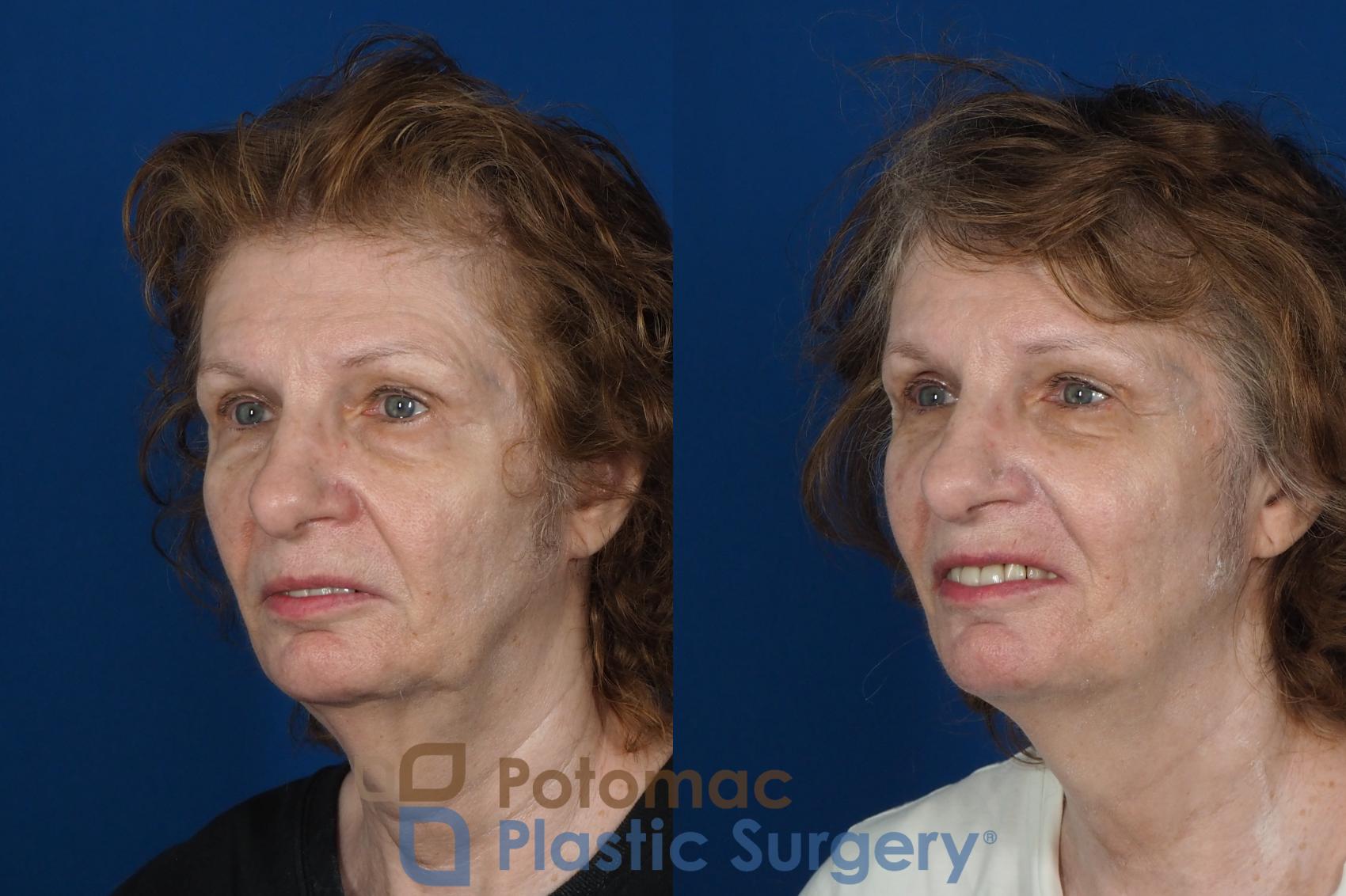 Before & After Brow Lift Case 245 Left Oblique View in Washington DC & Arlington , DC