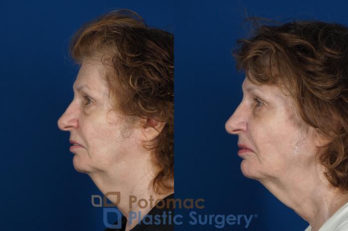 Before & After Brow Lift Case 245 Left Side View in Washington DC & Arlington , DC