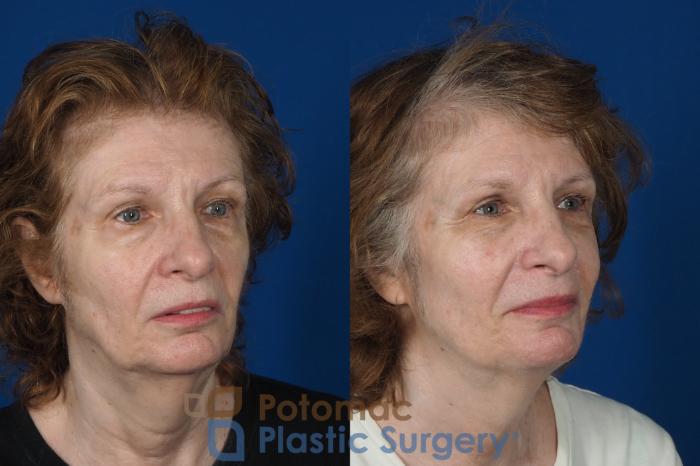 Before & After Brow Lift Case 245 Right Oblique View in Washington DC & Arlington , DC