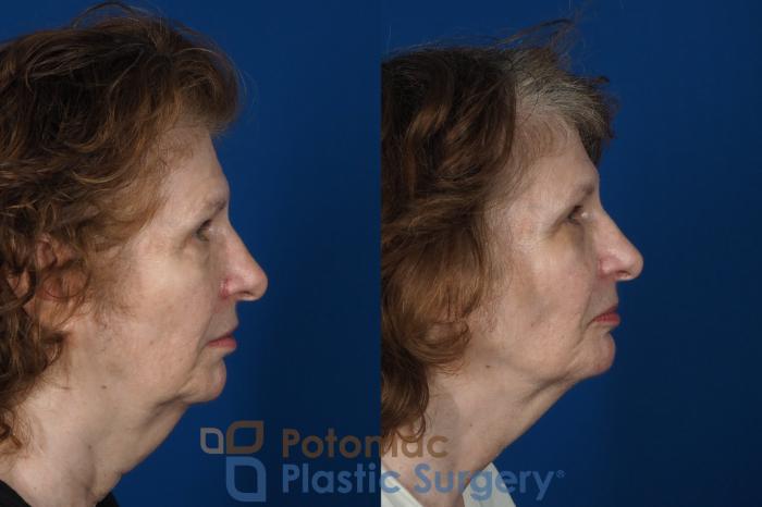Before & After Brow Lift Case 245 Right Side View in Washington DC & Arlington , DC