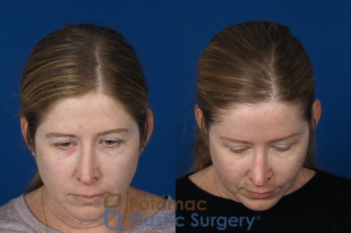 Before & After Brow Lift Case 265 Above View in Washington, DC