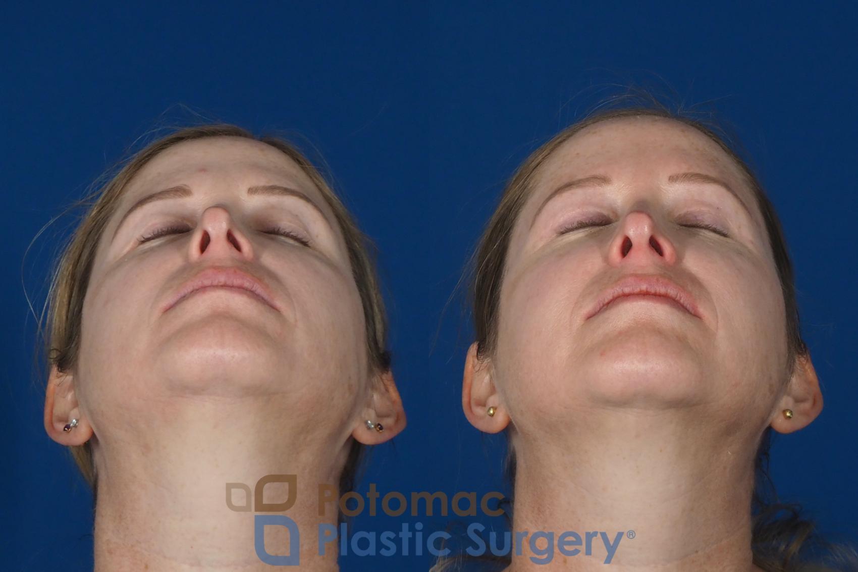 Before & After Brow Lift Case 265 Below View in Washington DC & Arlington , DC
