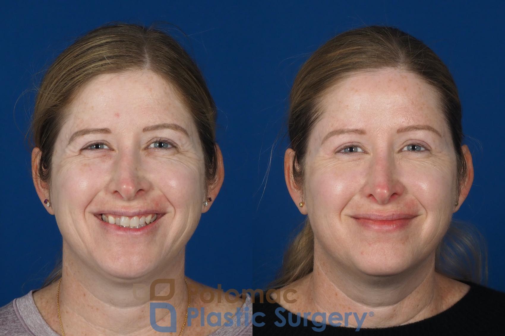 Before & After Brow Lift Case 265 Front View #2 View in Washington DC & Arlington , DC