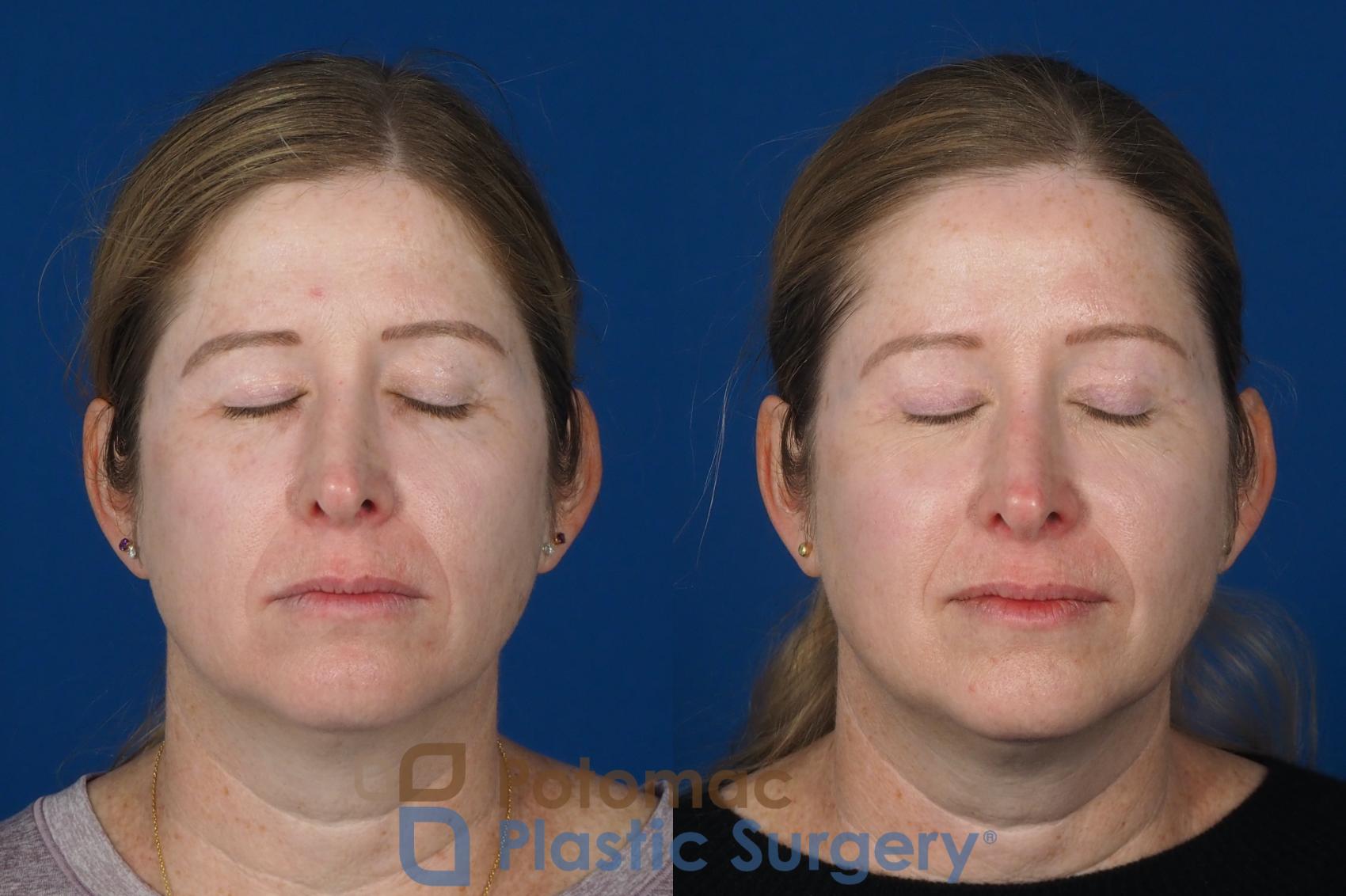Before & After Brow Lift Case 265 Front View #3 View in Washington DC & Arlington , DC