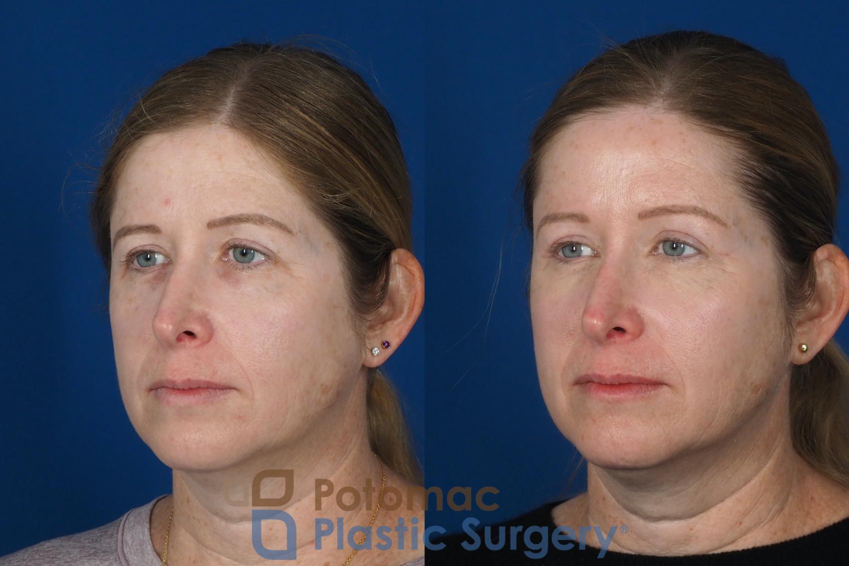 Before & After Brow Lift Case 265 Left Oblique View in Washington DC & Arlington , DC