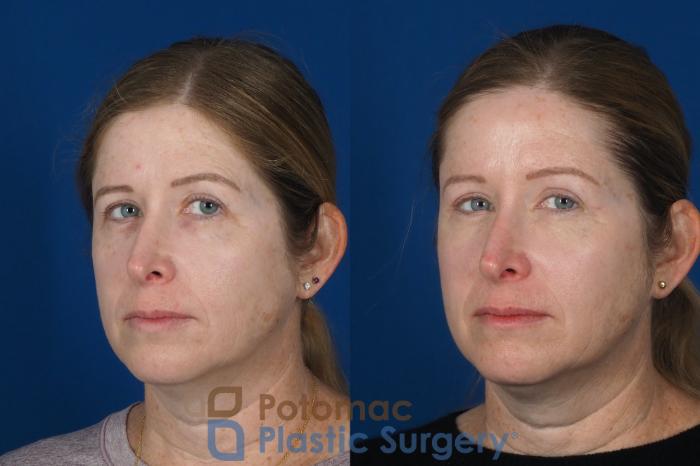 Before & After Brow Lift Case 265 Left Oblique View #2 View in Washington, DC