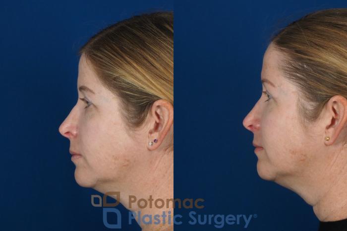 Before & After Brow Lift Case 265 Left Side View in Washington, DC