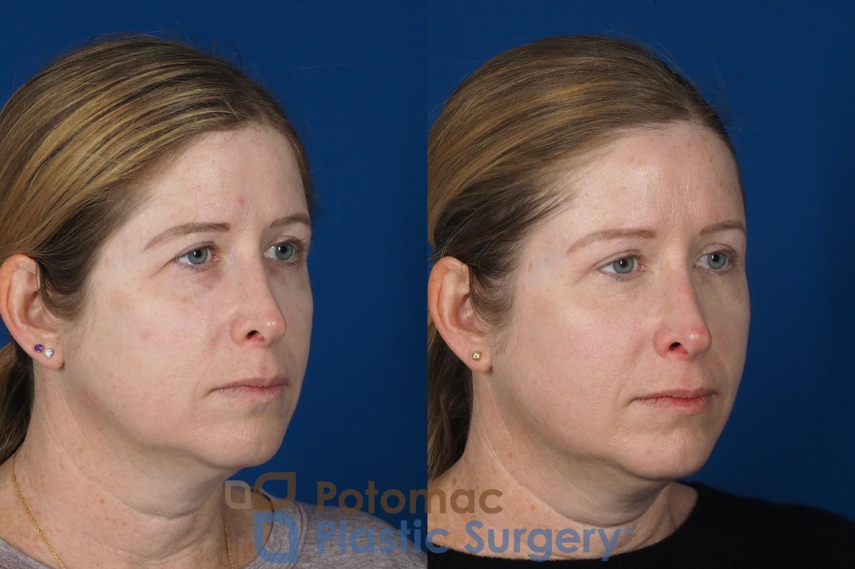Before & After Brow Lift Case 265 Right Oblique View in Washington DC & Arlington , DC