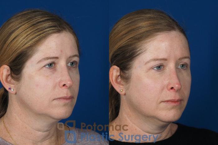 Before & After Brow Lift Case 265 Right Oblique View in Washington, DC