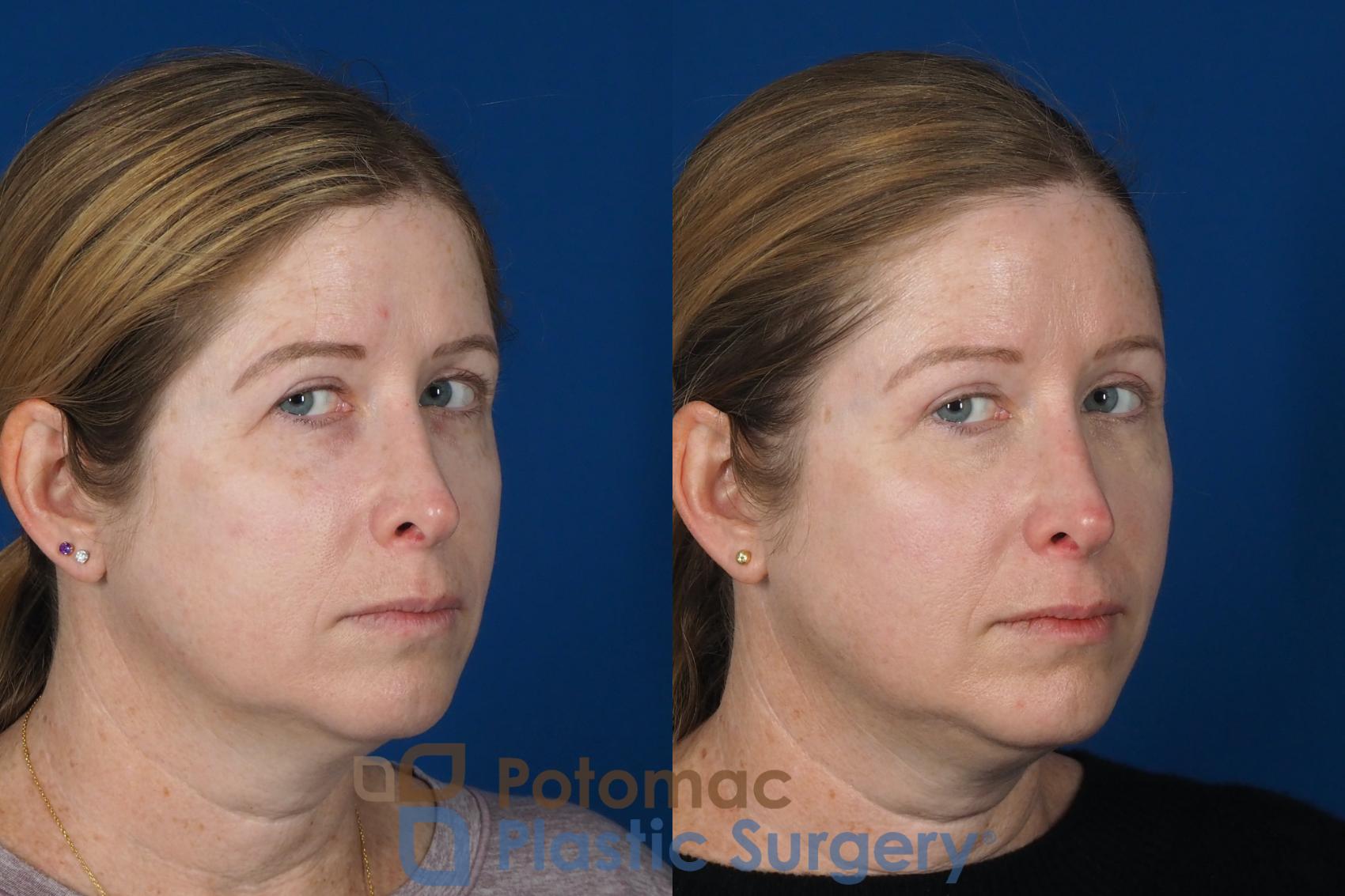 Before & After Brow Lift Case 265 Right Oblique View #2 View in Washington DC & Arlington , DC