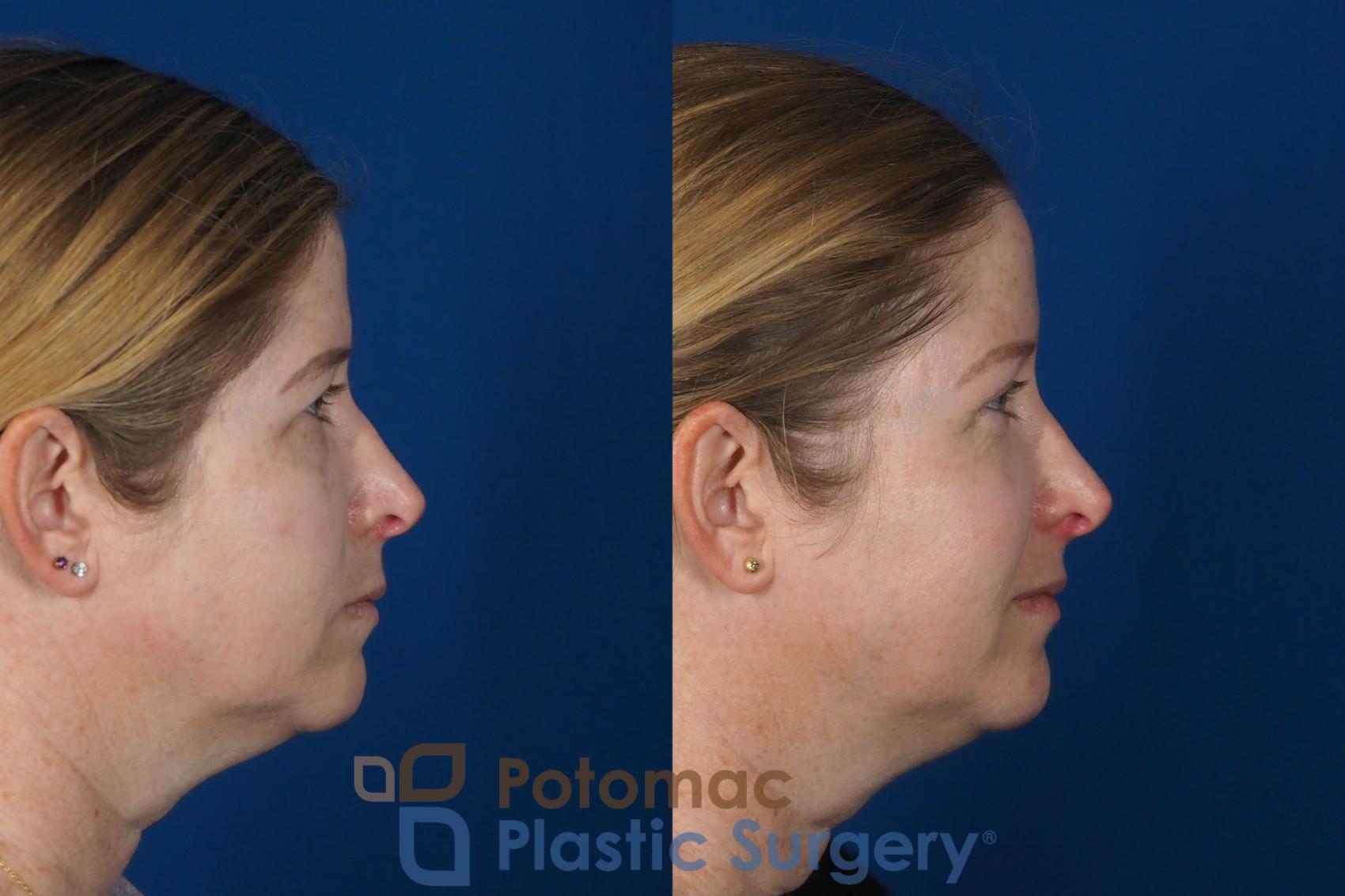 Before & After Brow Lift Case 265 Right Side View in Washington DC & Arlington , DC