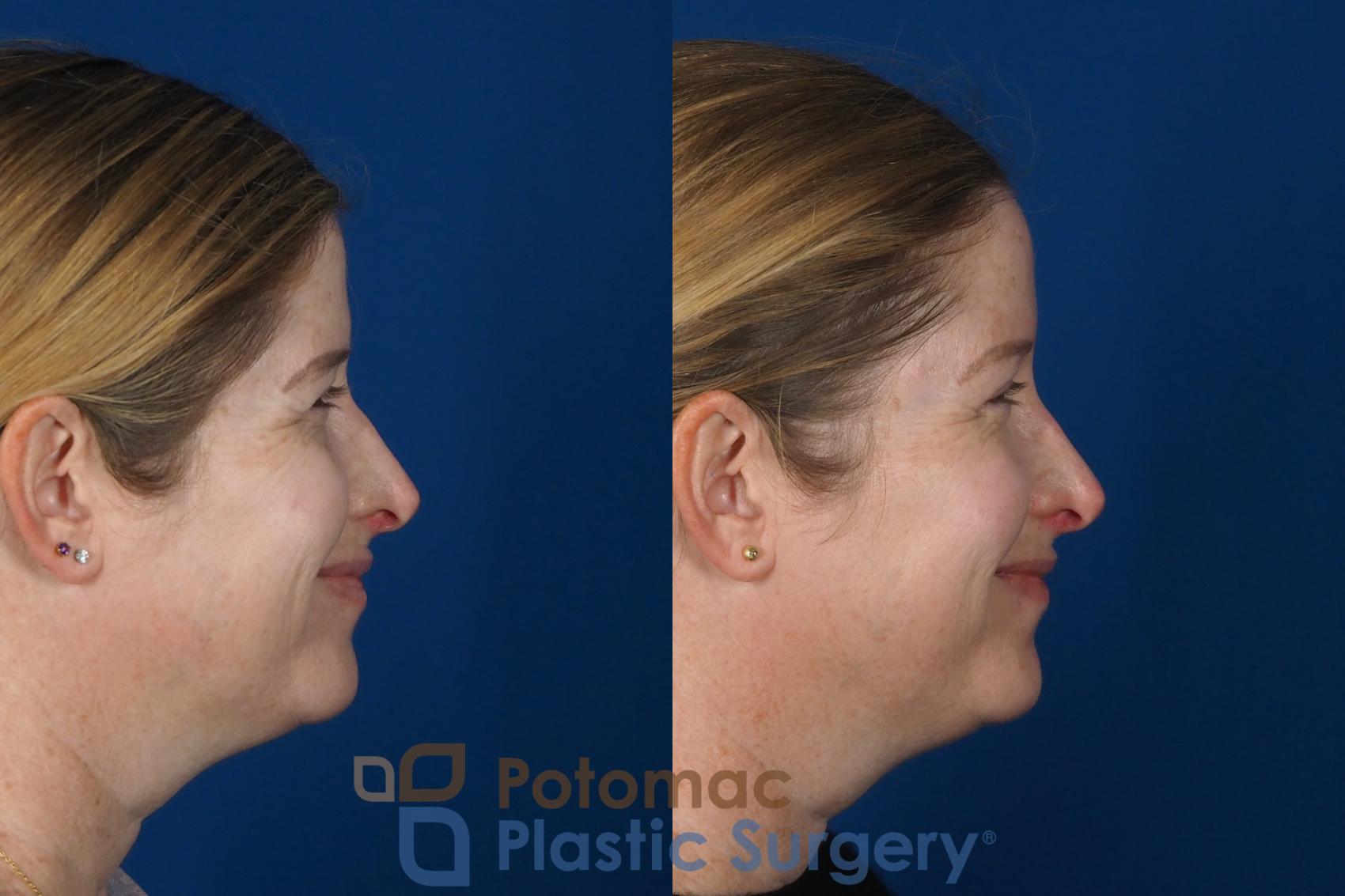 Before & After Brow Lift Case 265 Right Side View #2 View in Washington DC & Arlington , DC