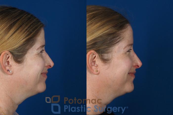 Before & After Brow Lift Case 265 Right Side View #2 View in Washington, DC
