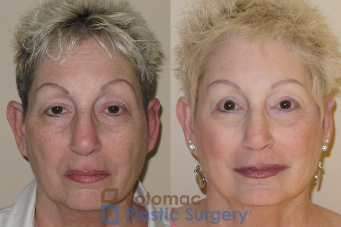 Before & After Brow Lift Case 28 Front View in Washington, DC
