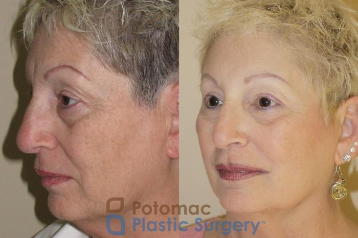 Before & After Brow Lift Case 28 Left Oblique View in Washington, DC