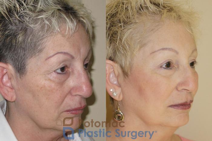 Before & After Brow Lift Case 28 Right Oblique View in Washington, DC