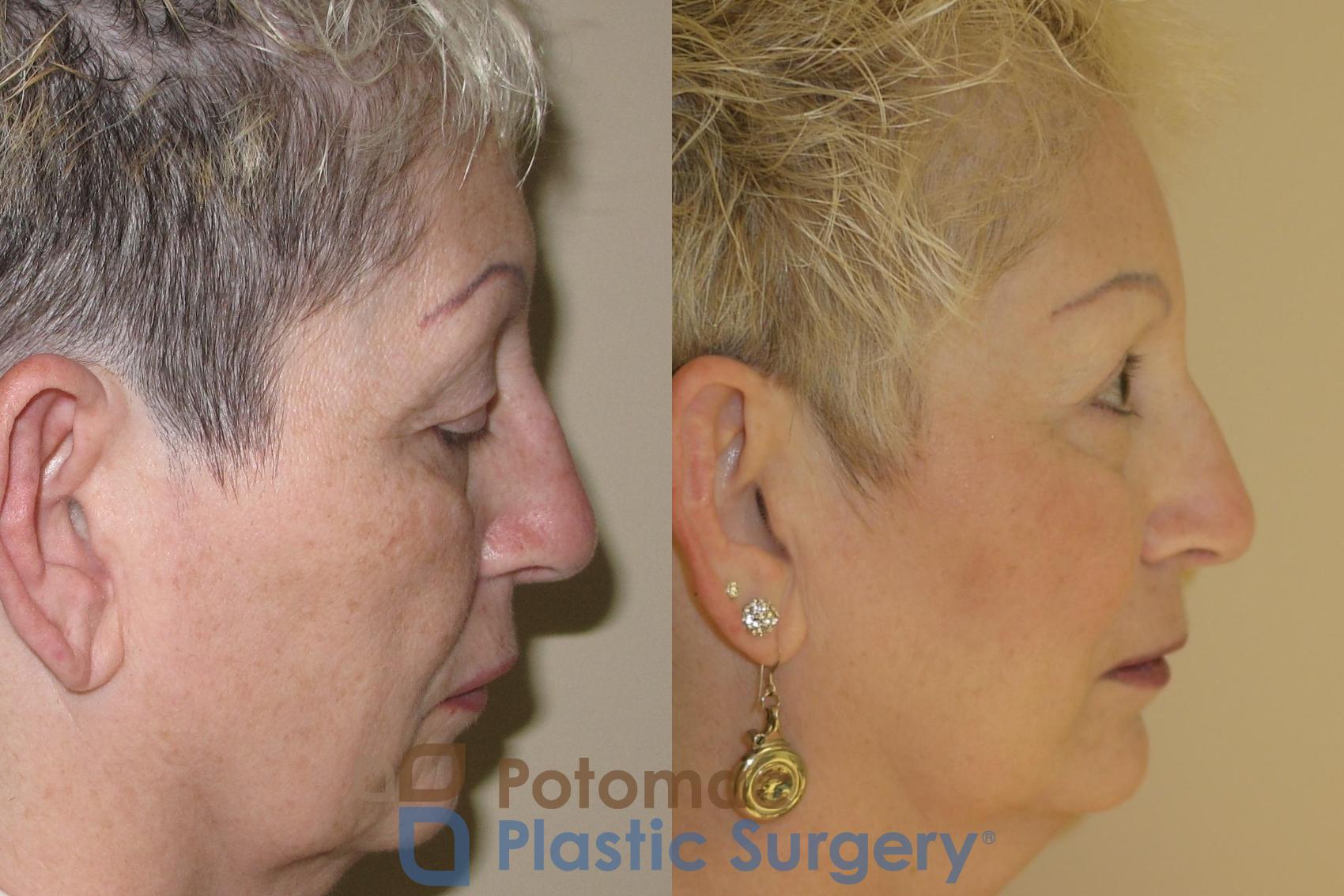 Before & After Brow Lift Case 28 Right Side View in Washington DC & Arlington , DC