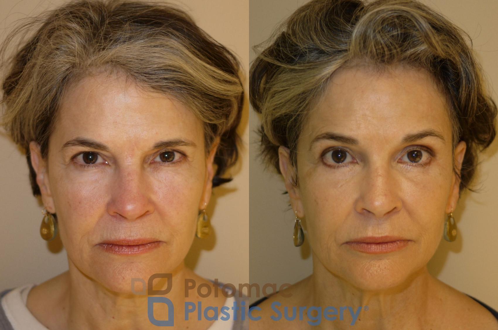 Before & After Blepharoplasty Case 33 Front View in Washington, DC