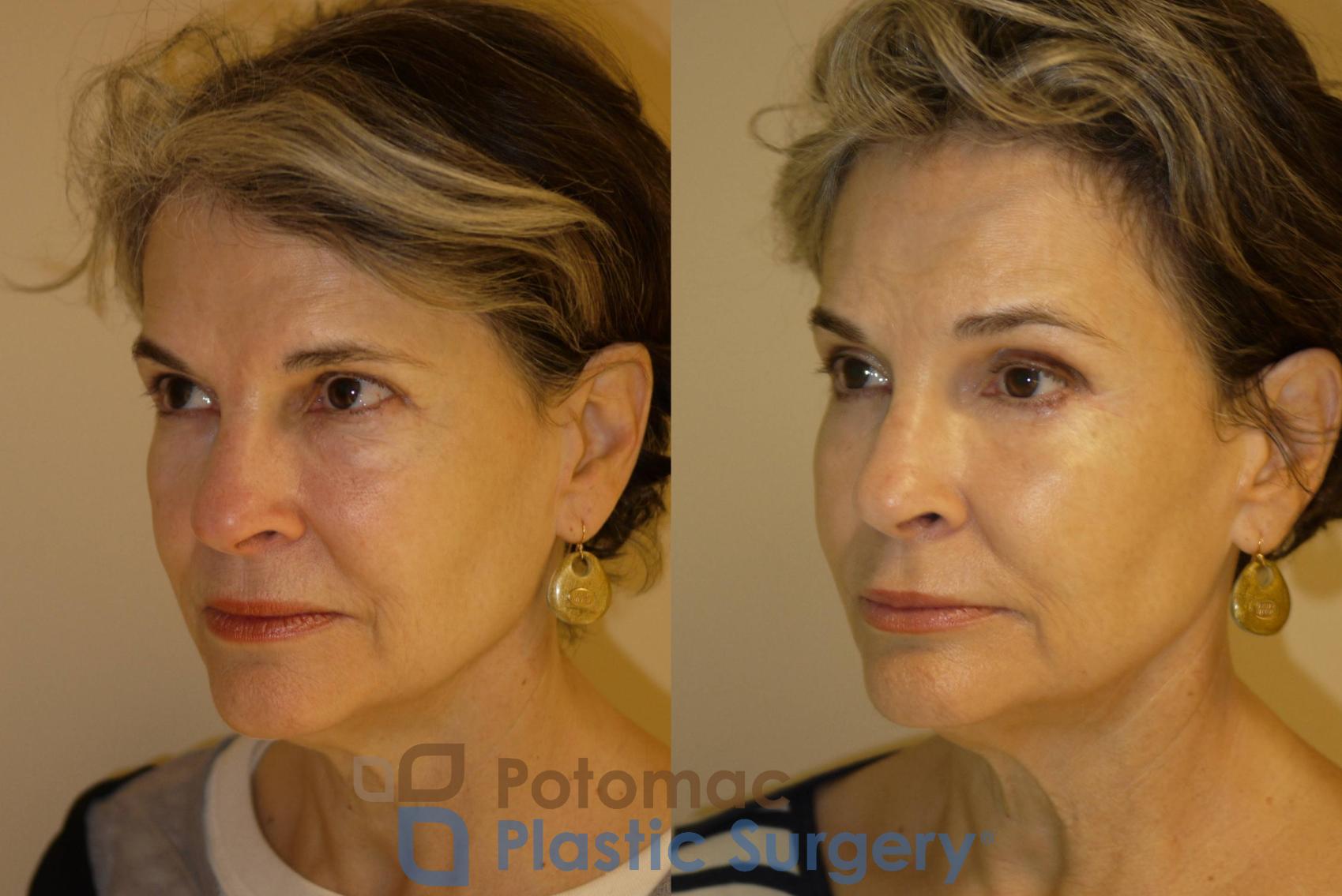 Before & After Brow Lift Case 33 Left Oblique View in Washington, DC