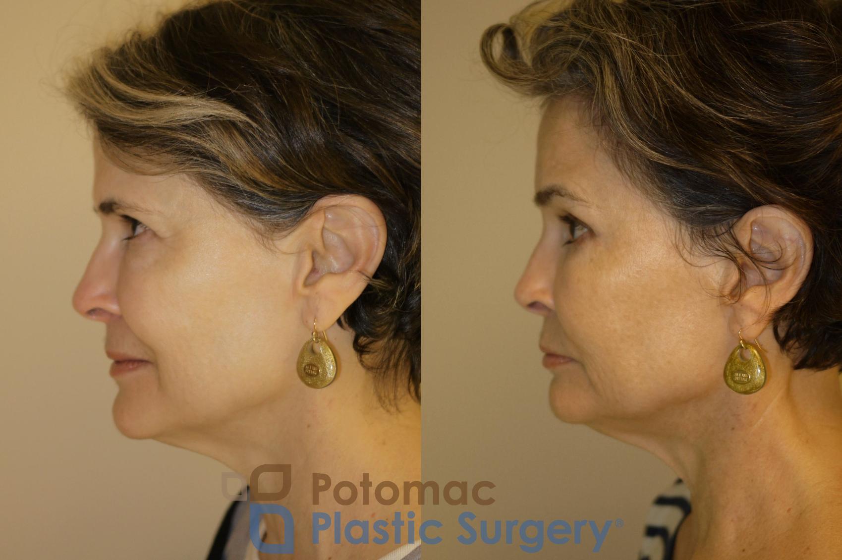 Before & After Brow Lift Case 33 Left Side View in Washington, DC