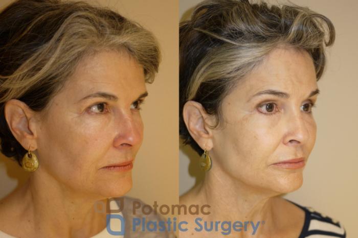 Before & After Brow Lift Case 33 Right Oblique View in Washington, DC