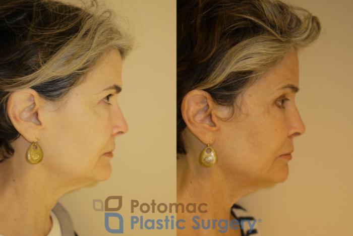 Before & After Brow Lift Case 33 Right Side View in Washington, DC