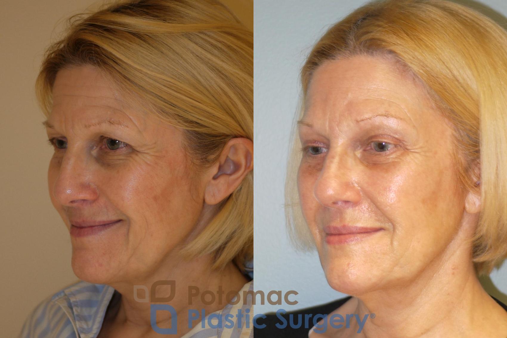 Before & After Blepharoplasty (Eyelid Surgery) Case 46 Left Oblique View in Washington DC & Arlington , DC
