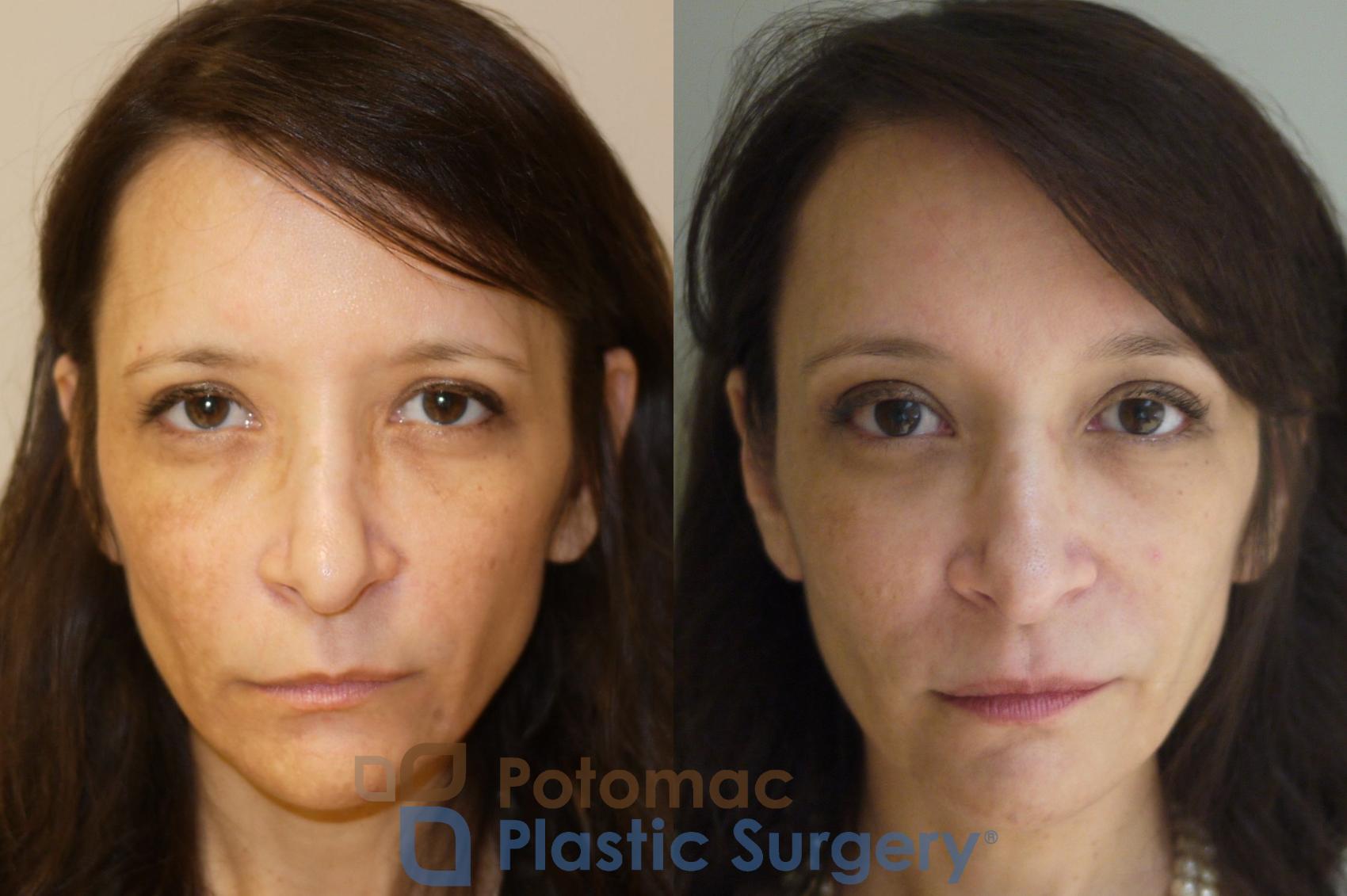 Before & After Brow Lift Case 57 Front View in Washington, DC