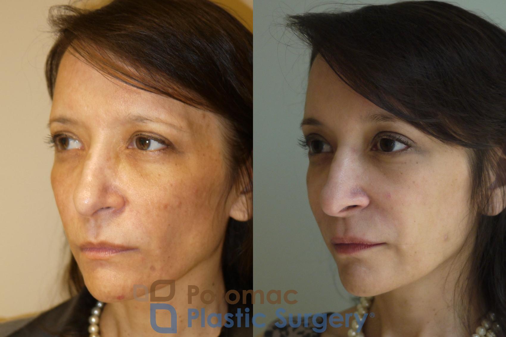 Before & After Brow Lift Case 57 Left Oblique View in Washington DC & Arlington , DC