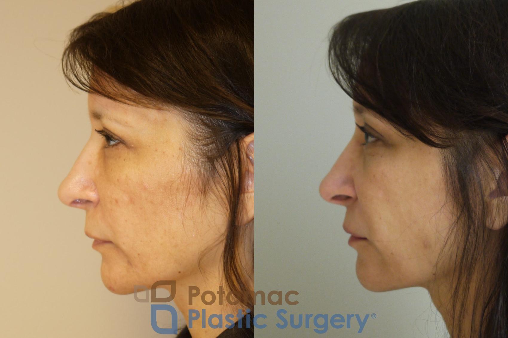 Before & After Brow Lift Case 57 Left Side View in Washington DC & Arlington , DC