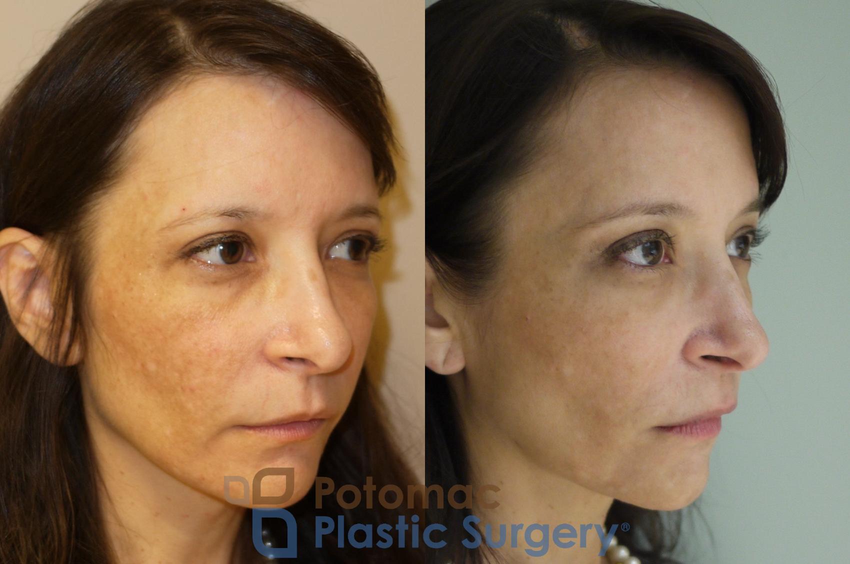 Before & After Brow Lift Case 57 Right Oblique View in Washington DC & Arlington , DC